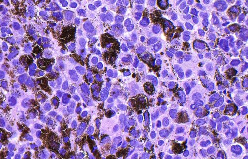Merck and Moderna released results of a late-stage trial that showed an experimental mRNA vaccine slashed the risk that melanoma returns by 42%.